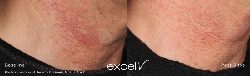 excel V™ laser treatments Stone Dermatology