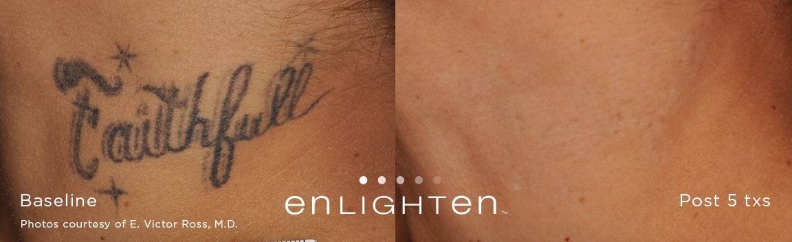 enlighten™ tattoo removal laser services Stone Dermatology