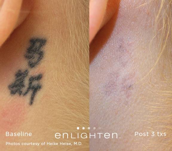 enlighten™ tattoo removal Stone Dermatology