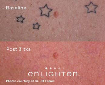 enlighten™ tattoo removal Stone Dermatology