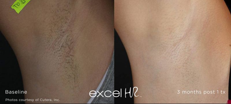 excel HR™ hair removal Stone Dermatology